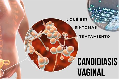 Candidiasis vaginal: imágenes, causas, síntomas y tratamiento